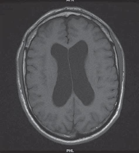 Case Study 3 Mri Axial View Showing Dilated Third Ventricles Secondary