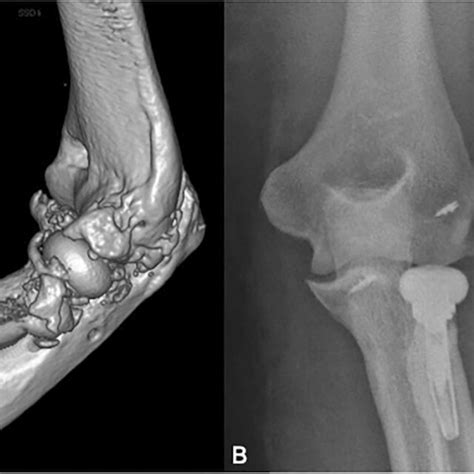 A Elbow Stiffness With Heterotopic Ossification After Radial Head