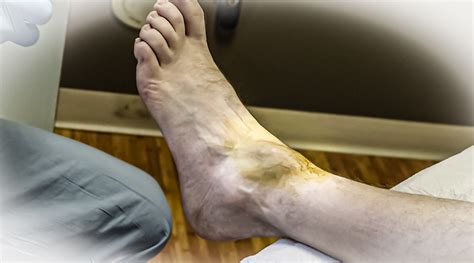 Ganglion Cyst Foot Surgery Recovery Time Causes Best Treatment