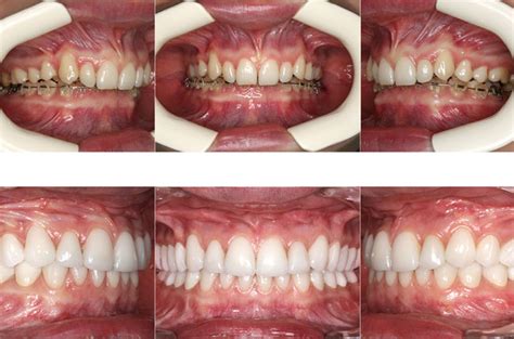 Orthognathic Facial Asymmetry Correction Corrective Jaw Surgery Dr