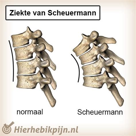 Scheuermann's disease, or scheuermann's kyphosis, is a condition in which the normal roundback in the upper spine is increased and results in a hunchback appearance, but rarely causes back pain. scheuerman