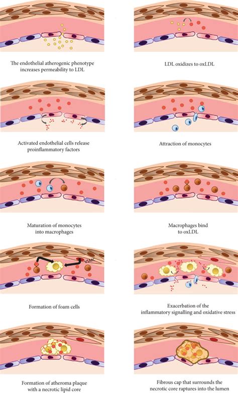Atheroma Plaque Formation Steps From Endothelial Dysfunction To Rupture