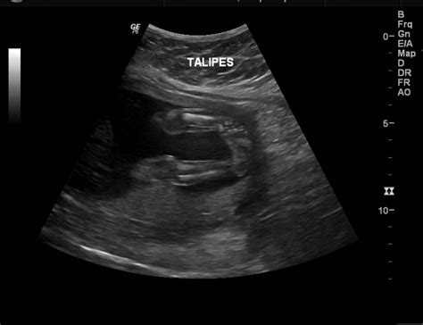 Clubfoot Ultrasound Clubfoot Fetal Skeletal Abnormalities Fetal