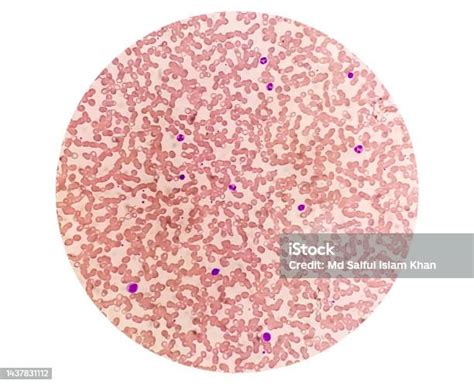 単球増加症を示す血液学的スライドの顕微鏡写真異常な単球 免疫系のストックフォトや画像を多数ご用意 免疫系 免疫蛍光顕微鏡写真 血漿