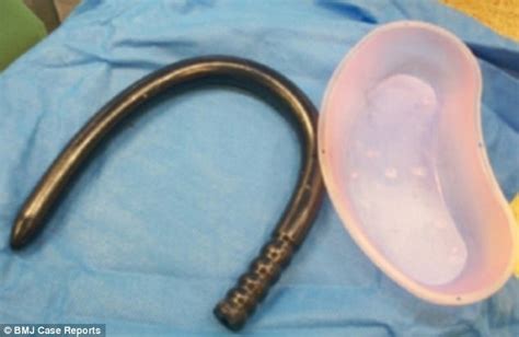 British Man 53 Inserts 77cm Long Sex Toy Up His Anus Daily Mail Online