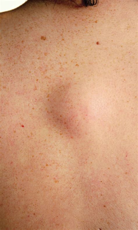Common Lumps And Bumps What Are They