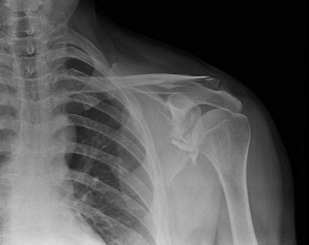 Scapular And Clavicular Fractures Radiology Case Radiopaedia Org