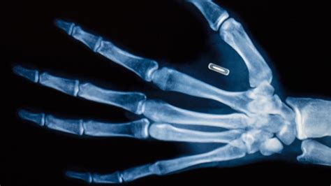 Implante De Microchip Na Mão A Marca Da Besta Chegou O Correio De Deus