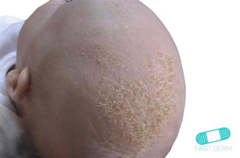 Online Dermatology Cradle Cap Seborrheic Dermatitis
