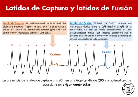 Cardiotruco Latidos De Captura Y Fusión Cardioprimaria Ferrol