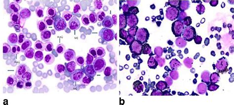 Mast Cell Leukemia Associated With Undefined Morphology And Chronic