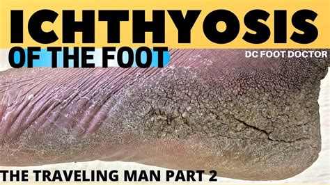 Ichthyosis Of The Foot Travelin Mans Severe Skin Condition And