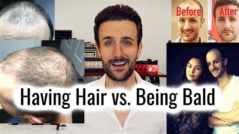 Having Hair Vs Being Bald My Experience Youtube