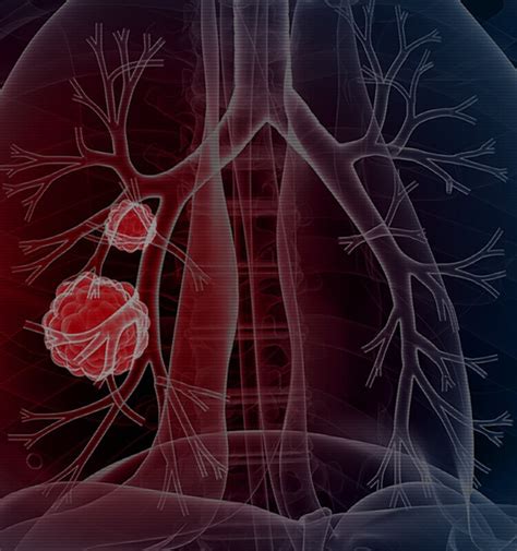 Most people who come to us for a lung cancer diagnosis first meet with a surgeon. Lung Cancer: Causes, Symptoms & Treatments | CTCA