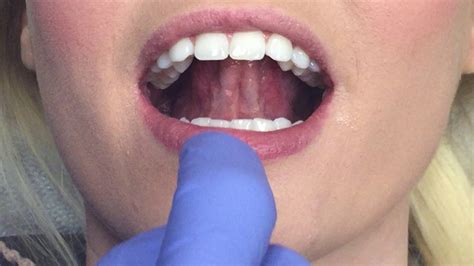 oral cancer screening youtube