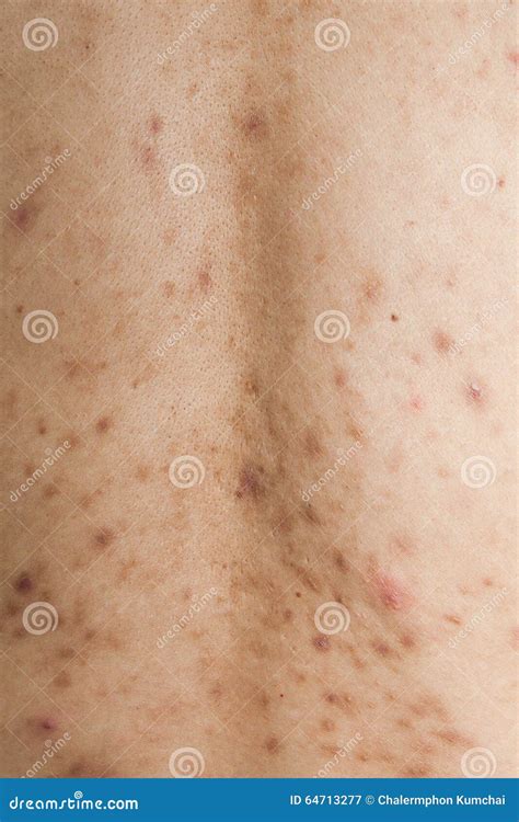Boy With Problematic Skin And Acne Scars Stock Image Image Of People