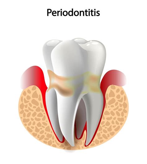 Types Of Periodontal Disease Dental Clinic In Ottawa On Kent