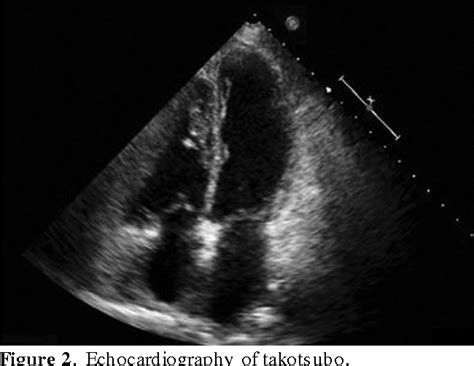 Figure 2 From A “broken Heart” Syndrome Case After Cesarean Delivery Prevention And Risk