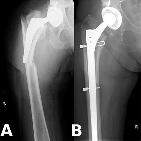 Example For Periprosthetic Femur Fracture A Vancouver B2 Type