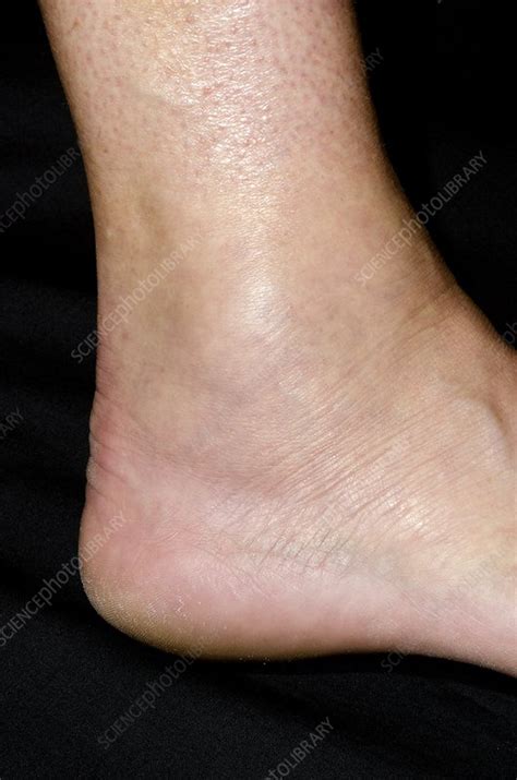 Sprained Ankle Stock Image C0142805 Science Photo Library