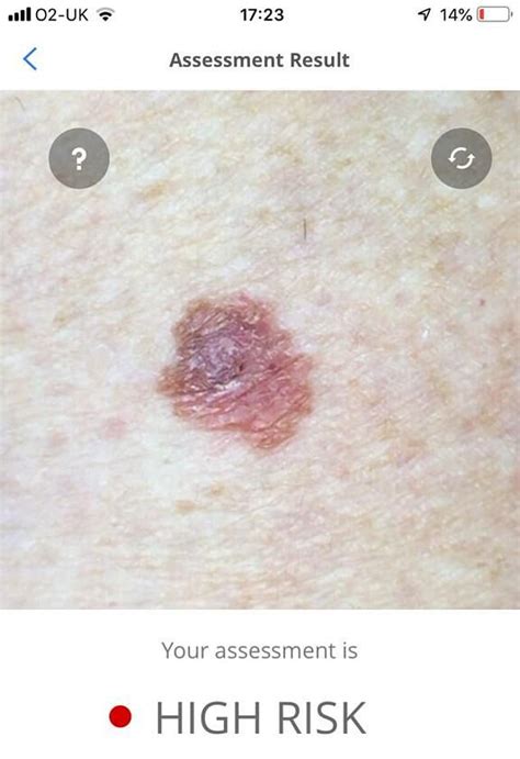 Nhs Worker 49 Discovers Cancerous Mole With Smartphone App All My
