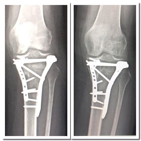 Tibia Fracture Ankle Tibial Plateau Fracture Recovery