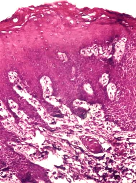 Gingival Mucosa Condyloma Acuminata With Koilocytes In An Epithelial