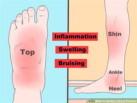 The forces that cause a stress fracture in the foot or ankle are similar. 3 Ways to Identify a Stress Fracture - wikiHow