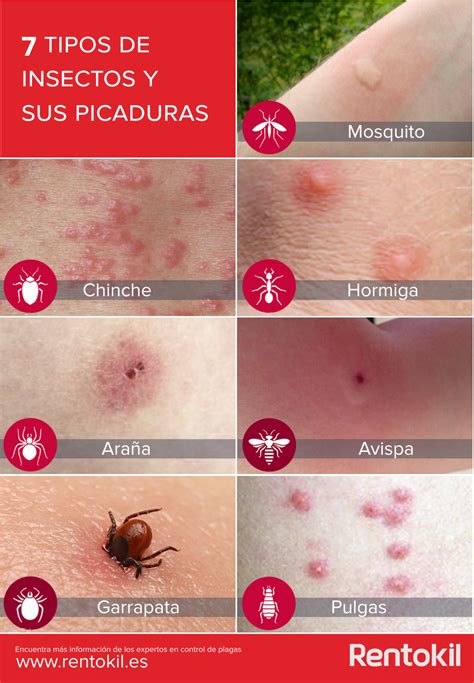 Identificando Picaduras De Insectos Desinfestados Carlos Packer