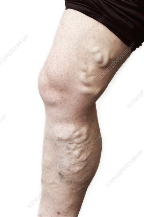 Varicose Veins In The Leg Stock Image C0103354 Science Photo Library