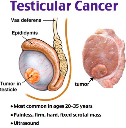 How To Spot Testicular Cancer Signalsteel
