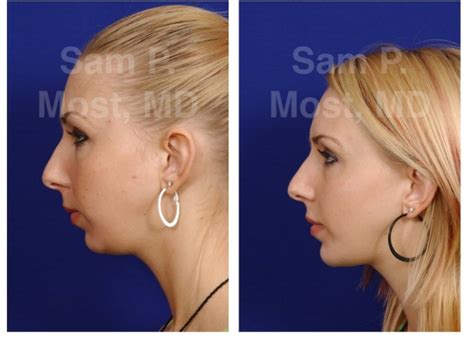 Chin Augmentation Facial Plastic And Reconstructive Surgery