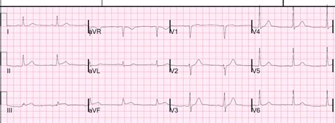 Dr Smiths Ecg Blog Chest Pain In A Patient With