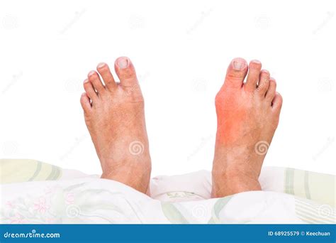 Right Foot With Painful Swollen Gout Inflammation Resting On Bed Stock
