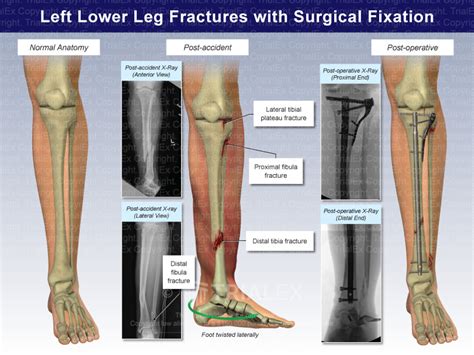 Left Lower Leg Fractures With Surgical Fixation Trial Exhibits