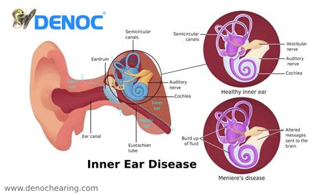 Inner Ear Disease Ear Diseases Inner Ear Disease