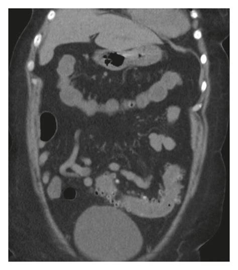 Ct Abdomen And Pelvis Without Contrast Showing Mild Inflammation