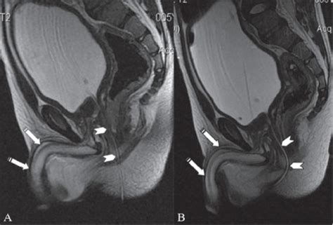 Sagittal T2w Images Show A Small Caliber Cannula In The Anterior