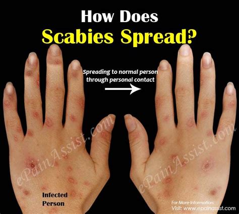 Scabies Diagnosis Treatment Healthsoul Vrogue Co