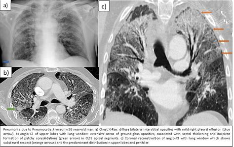 Pneumocystis Jiroveci Pneumonia In A Patient Without Hiv Serau