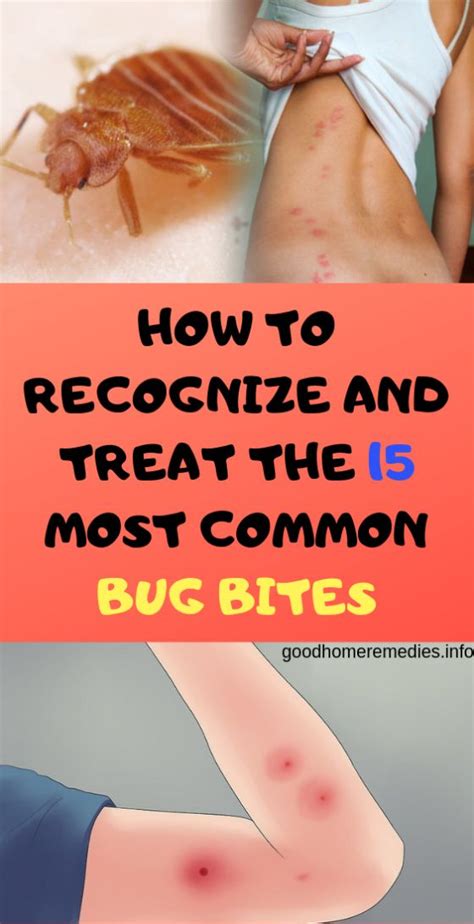 How To Recognize And Treat The 15 Most Common Bug Bites Good Home Remedies Bug Bites