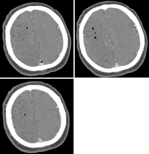 Cerebral Air Embolism Complicating Transbronchial Lung Biopsy A Case