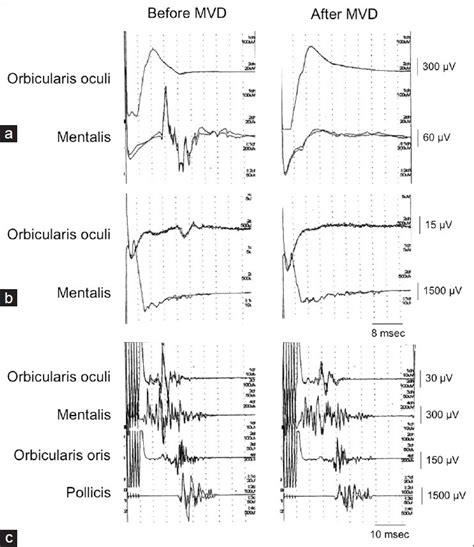 Intraoperative Abnormal Muscle Response Amr From The Mentalis A And