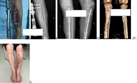 Application Of Multiple Wrapped Cancellous Bone Graft Methods For