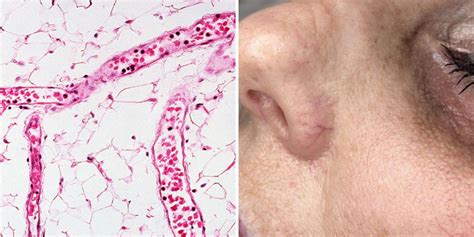 7 Ways To Prevent And Get Rid Of Broken Capillaries — Dr Oz The Good