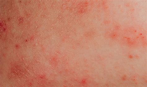 Itchy Skin Four Causes Of Irritation If You Also Have A Rash And What
