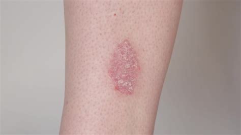 Close Detail Red Scaly Flaky Dry Abnormal Skin Human Elbows — Stock