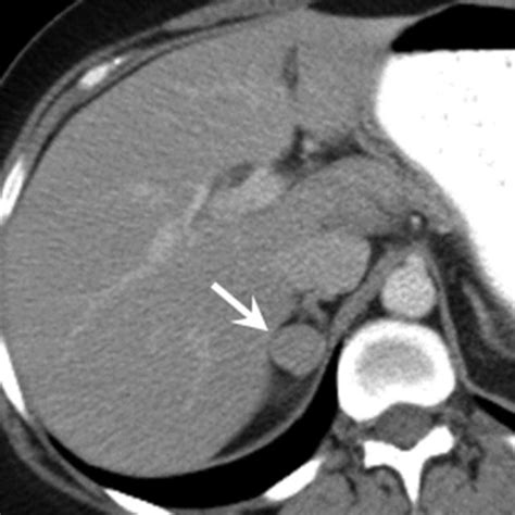 An Example Of Adrenal Metastasis Demonstrating Washout In A 67 Year Old