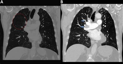 Lung Ct Scan Without Contrast