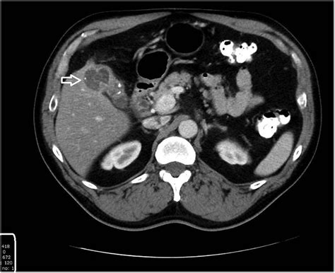 Ct Of The Abdomen And Pelvis With Oral Contrast Revealing Abnormal